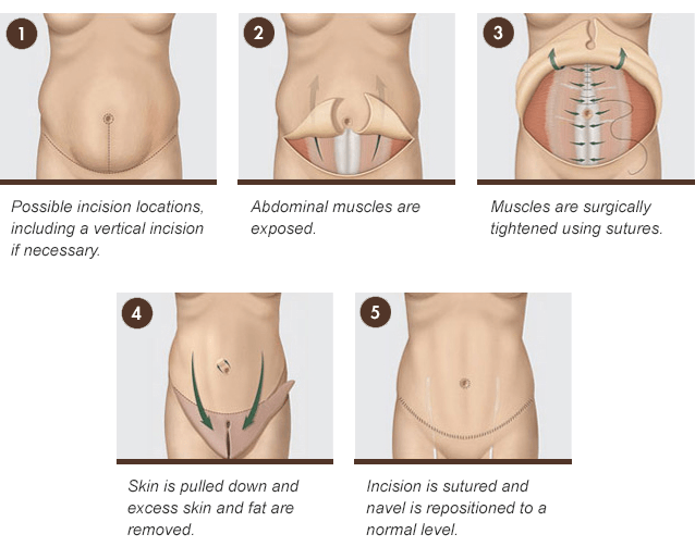 Benefits of a Tummy Tuck After a C-Section in Birmingham, AL