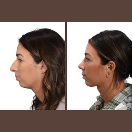 Add Definition to Your Chin and Jawline with Deep Neck Contouring