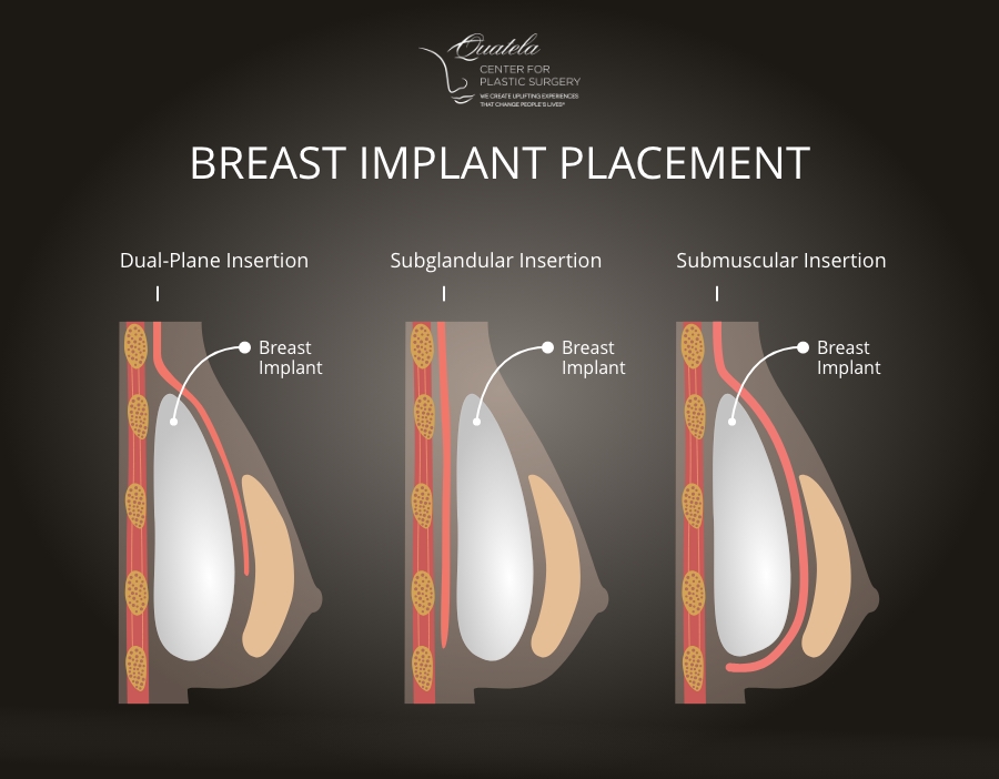 What does drop and fluff mean after breast augmentation?