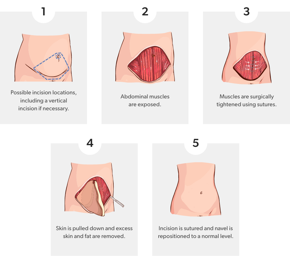 Steps of a tummy tuck