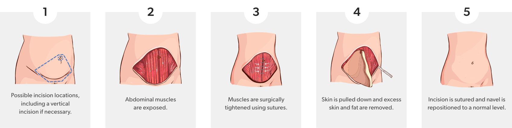 Steps of a tummy tuck